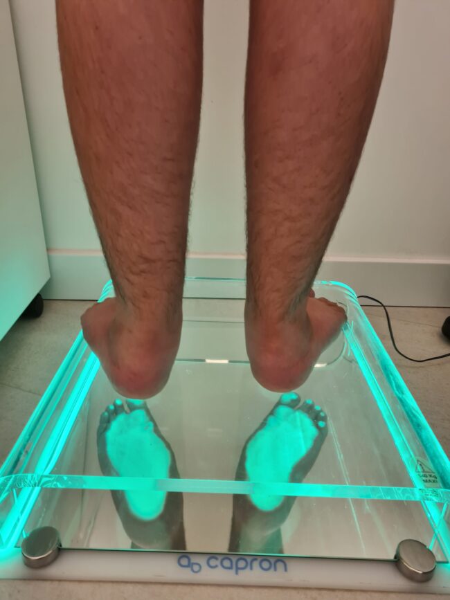 piede piatto di 3°